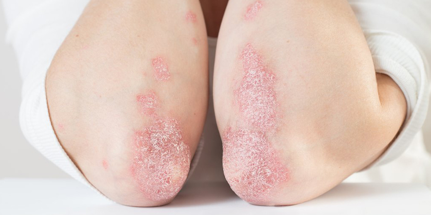 psoriasis