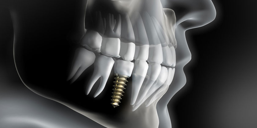 Implant basal